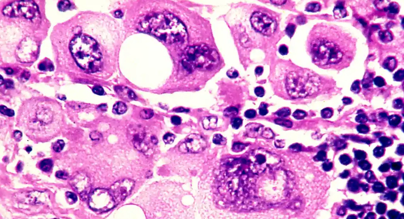 Image of melanoma cells through a microscope